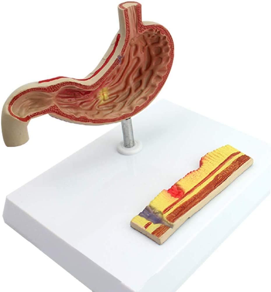 LBYLYH Digestive System Anatomical Model Human Stomach Model With Gastric Ulcer Disease Digestive System Model