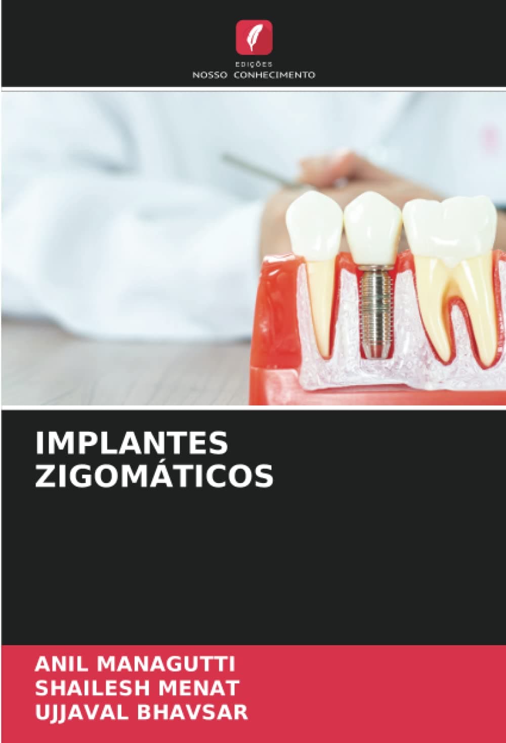 IMPLANTES ZIGOMÁTICOS (Portuguese Edition)