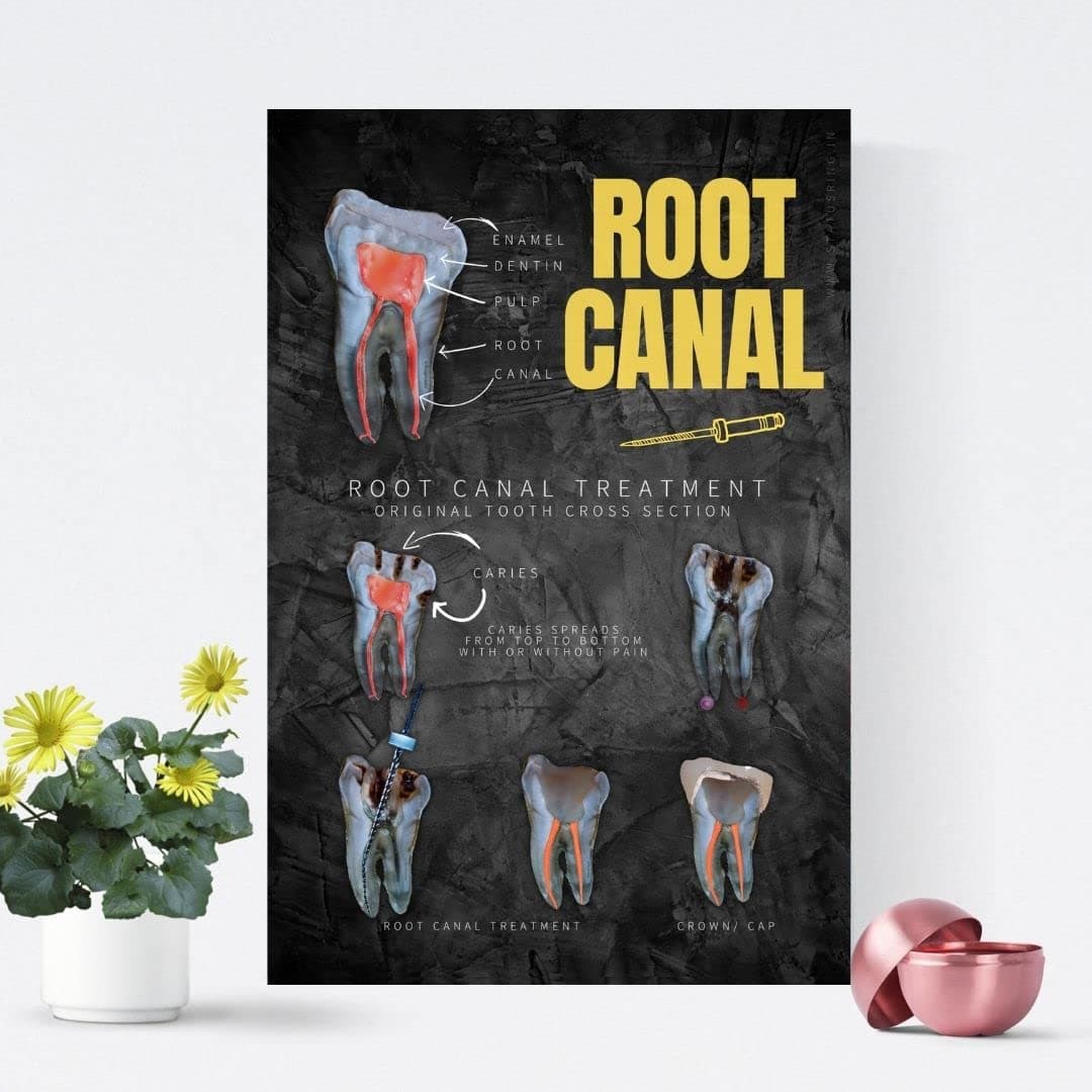 Root canal CS explained patient education Dental poster for dentist clinic without frame