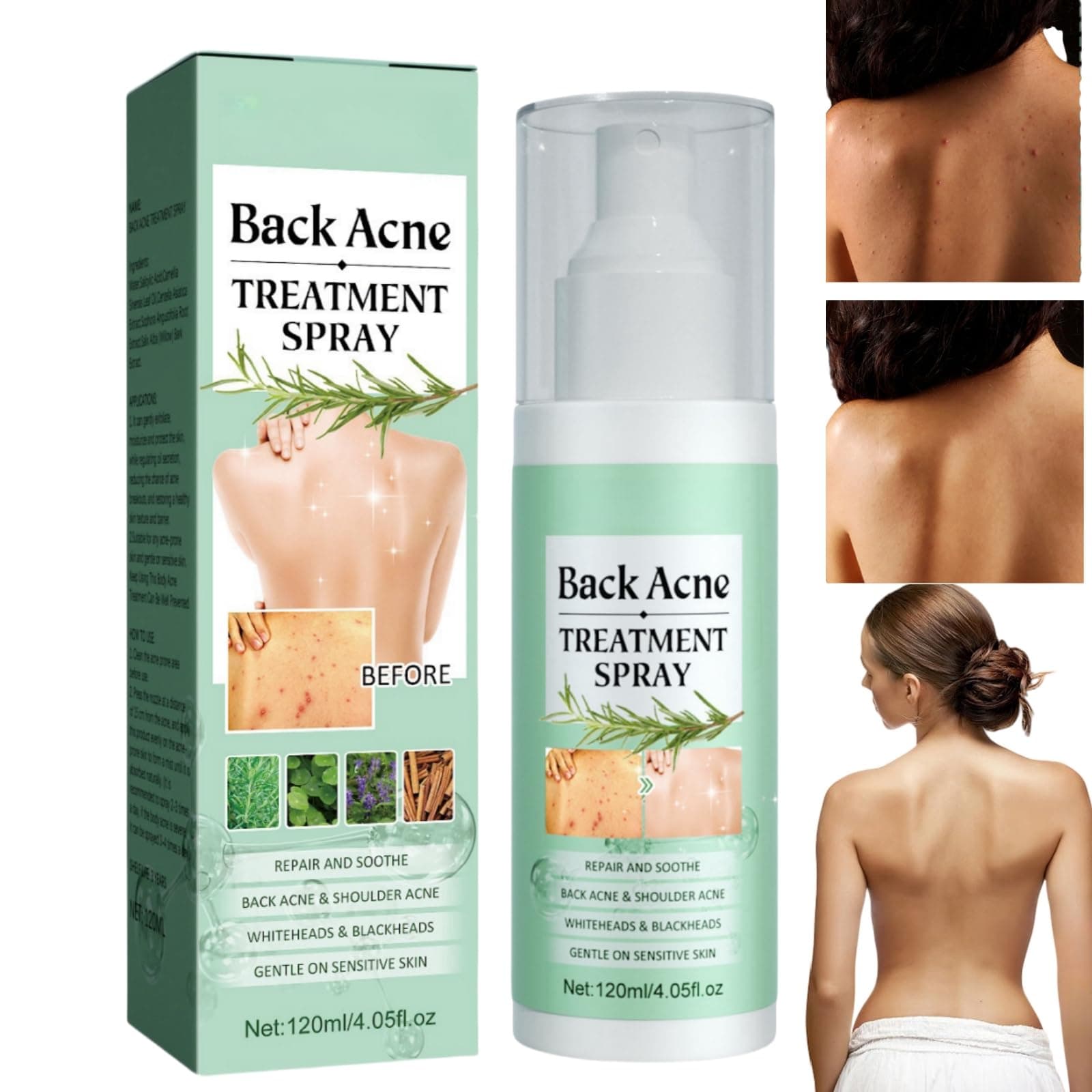 Acne Treatment Spray for Back & Body - 120ml