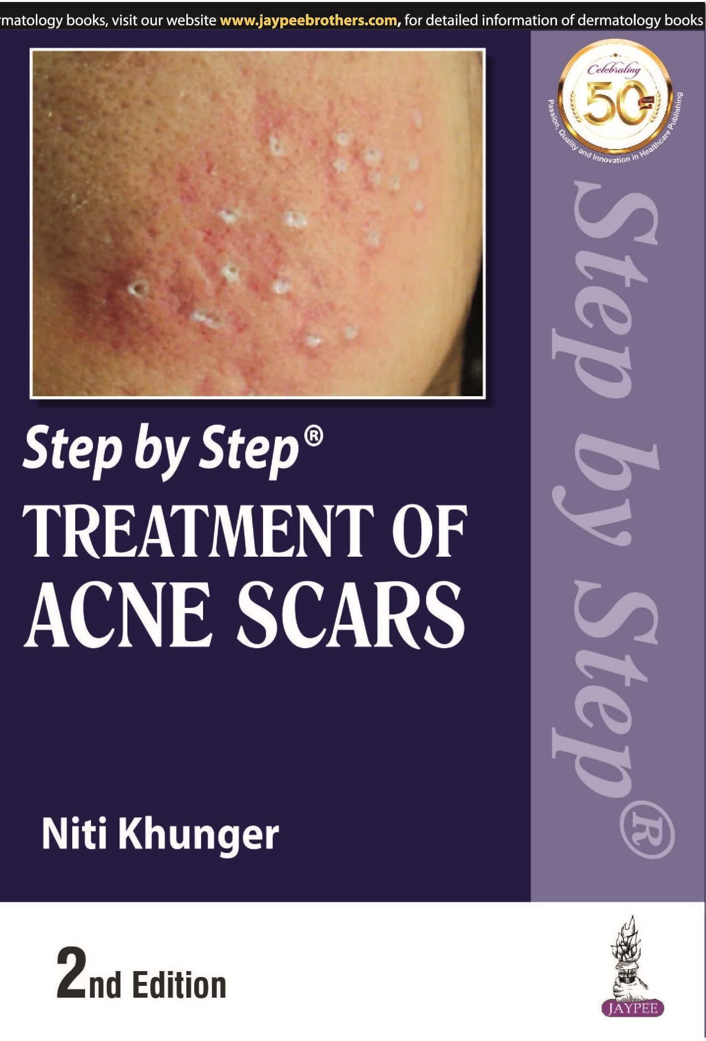 Step by Step Treatment of Acne Scars