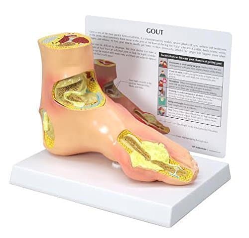 Foot Gout Anatomical Model w Educational Key Card