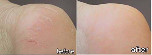 Special Set (3 Hand + 3 Foot) for Dry, Rough, Calloused, Cracked Skin